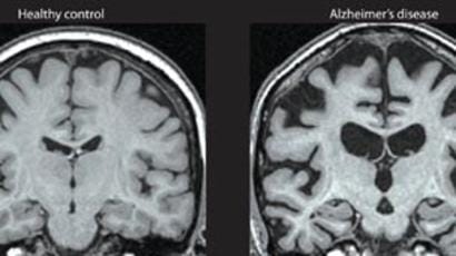alzheimers brain shrinkage