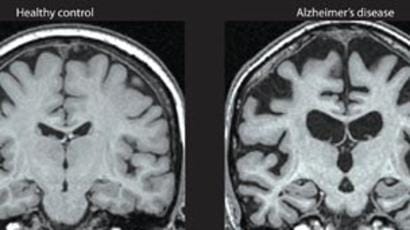 How to Prevent Alzheimers 2020 Update 1 alzheimers brain shrinkage